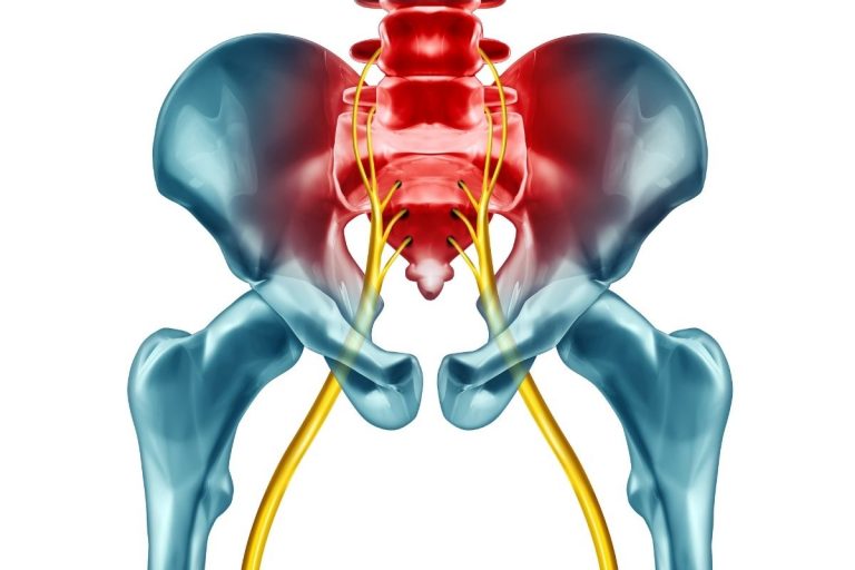 Sciatica Physiotherapy: Treatments & Exercises to Reduce Pain - Thrive ...