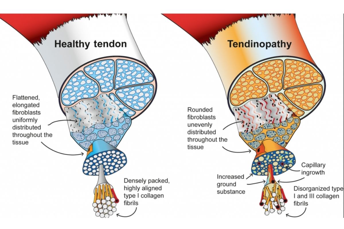 degenerative vs healthy gluteal tendon
